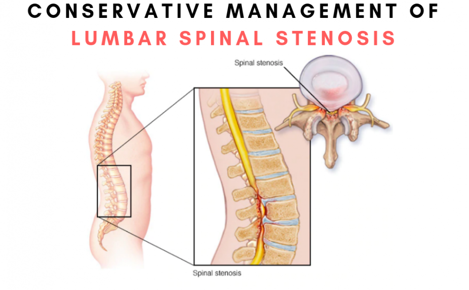 stenosis of the lumbar canal